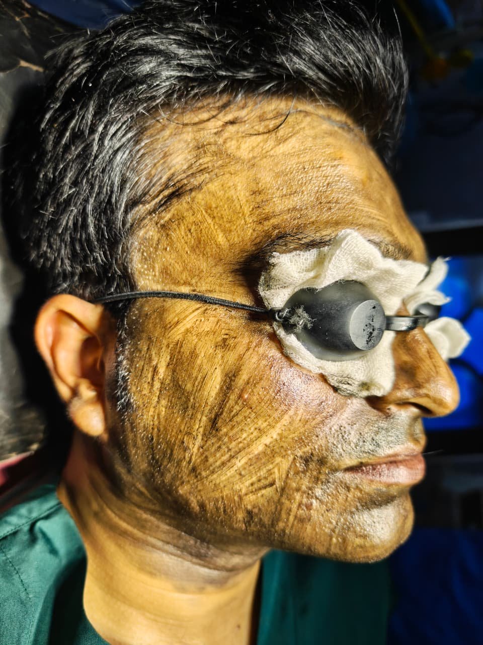 Acne Scar Treatment Results