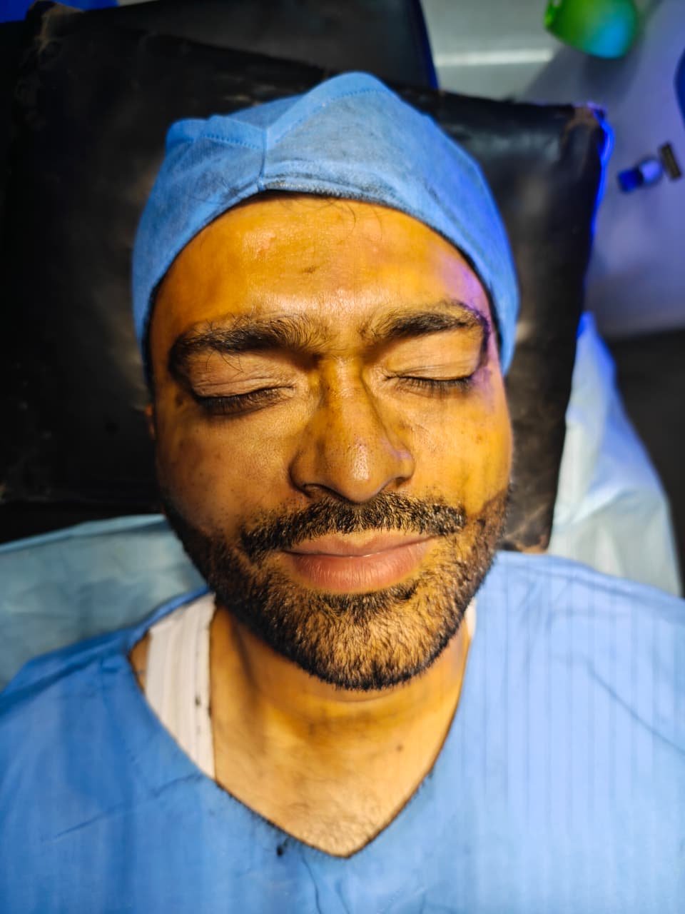 Acne Scar Treatment Results