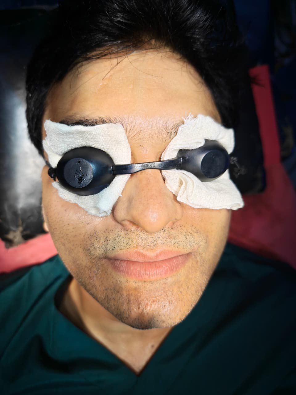 After Acne Scar
