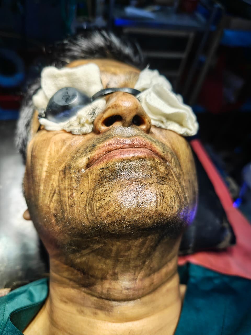 Before HydraFacial