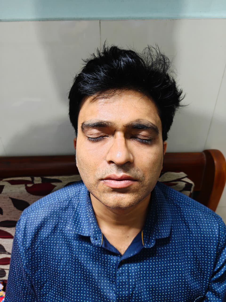 Before Hair Transplant