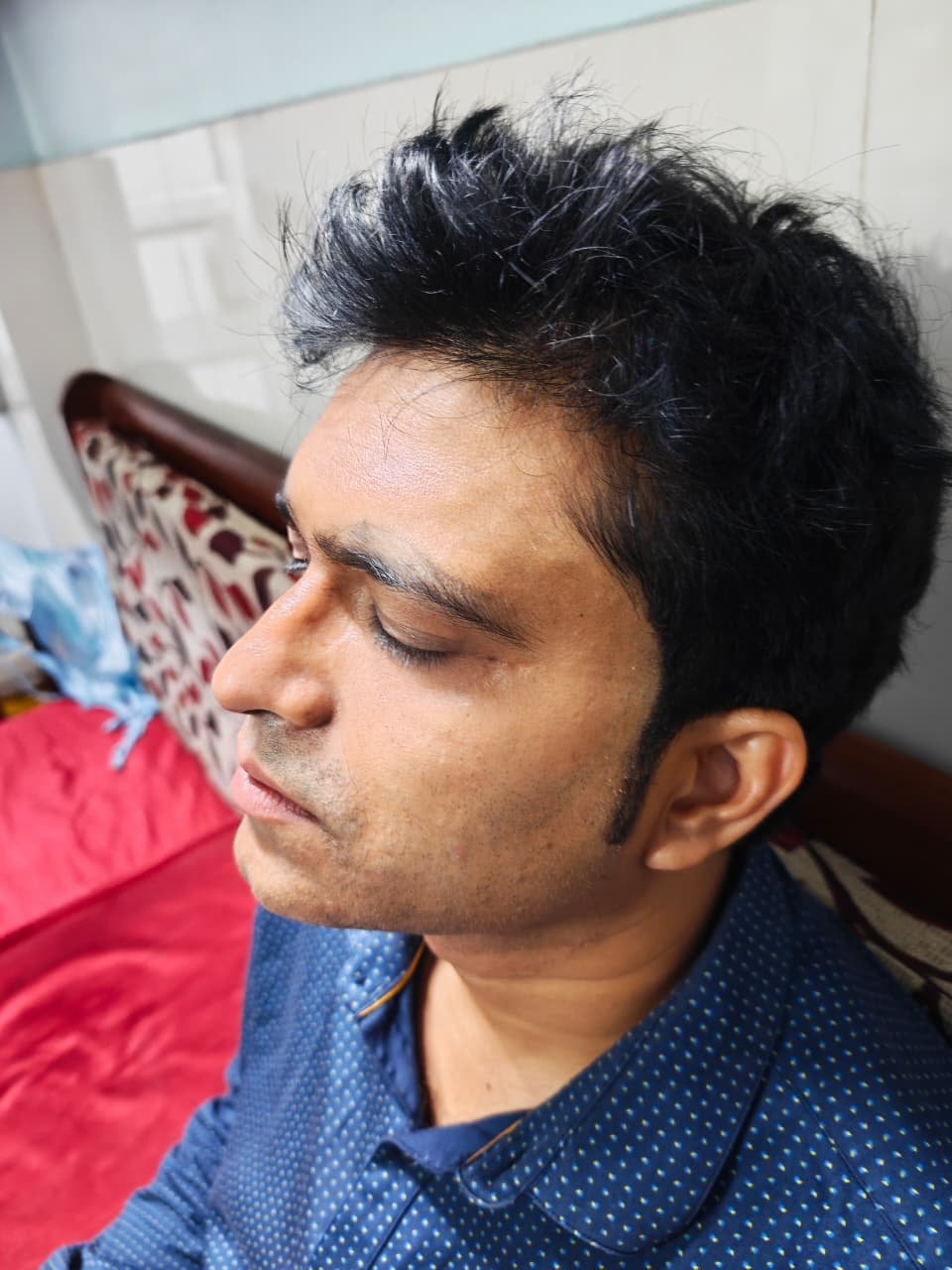 Acne Scar Treatment Results