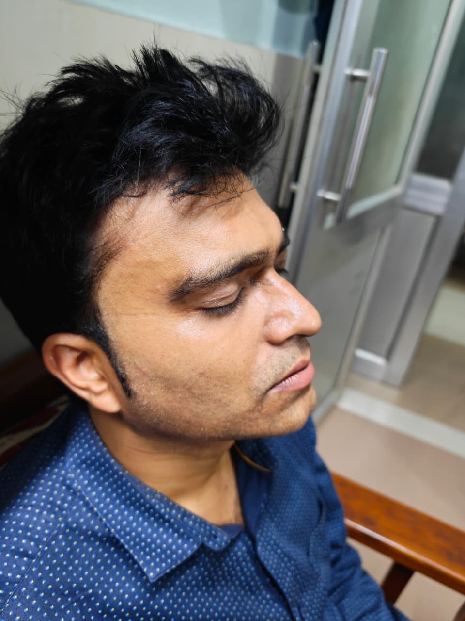 After Hair Transplant